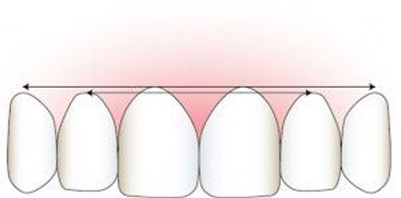gum lift illustration