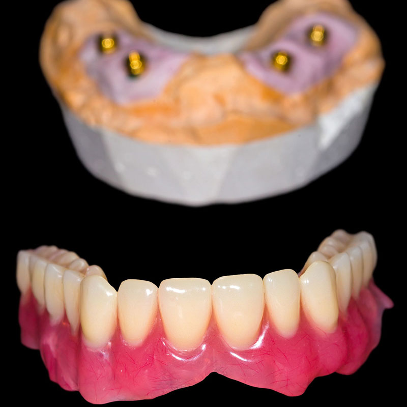 implant-supportedDentures