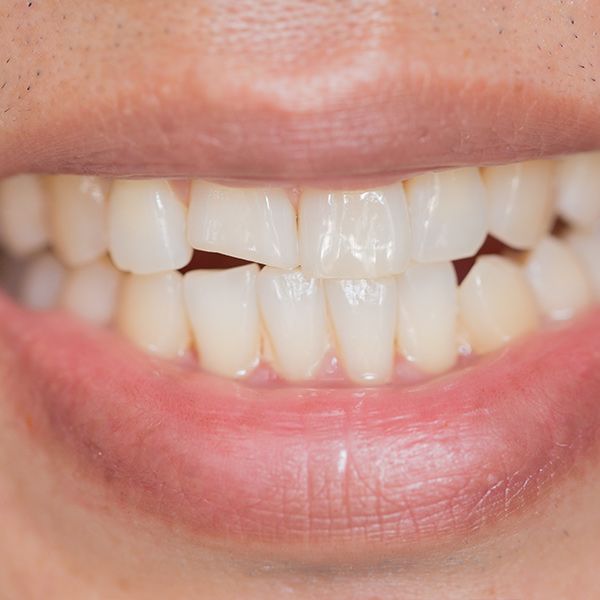 original_CrackedTooth