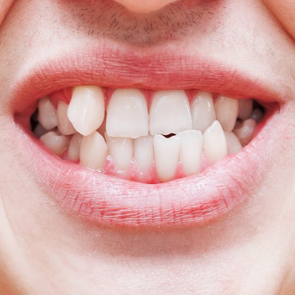 original_CrookedTeeth