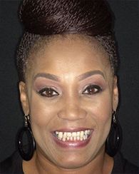 original_DentalImplants-Before