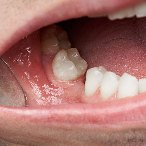 original_missingtooth