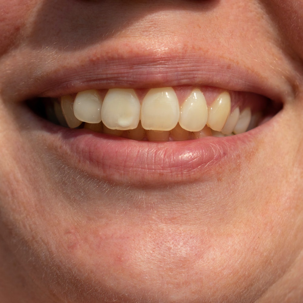 stained-discolored-teeth_1361950133